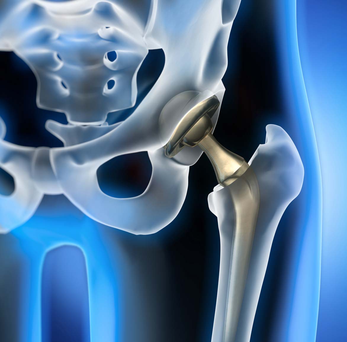 X-ray illustration of a hip replacement
