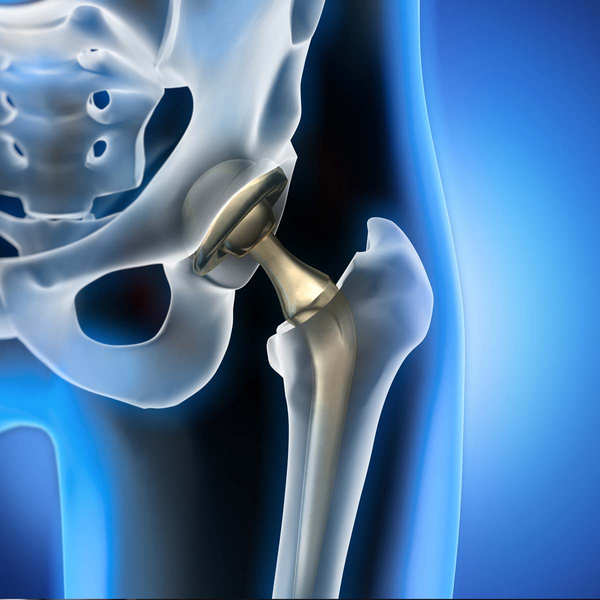 X-Ray illustration of a hip replacement