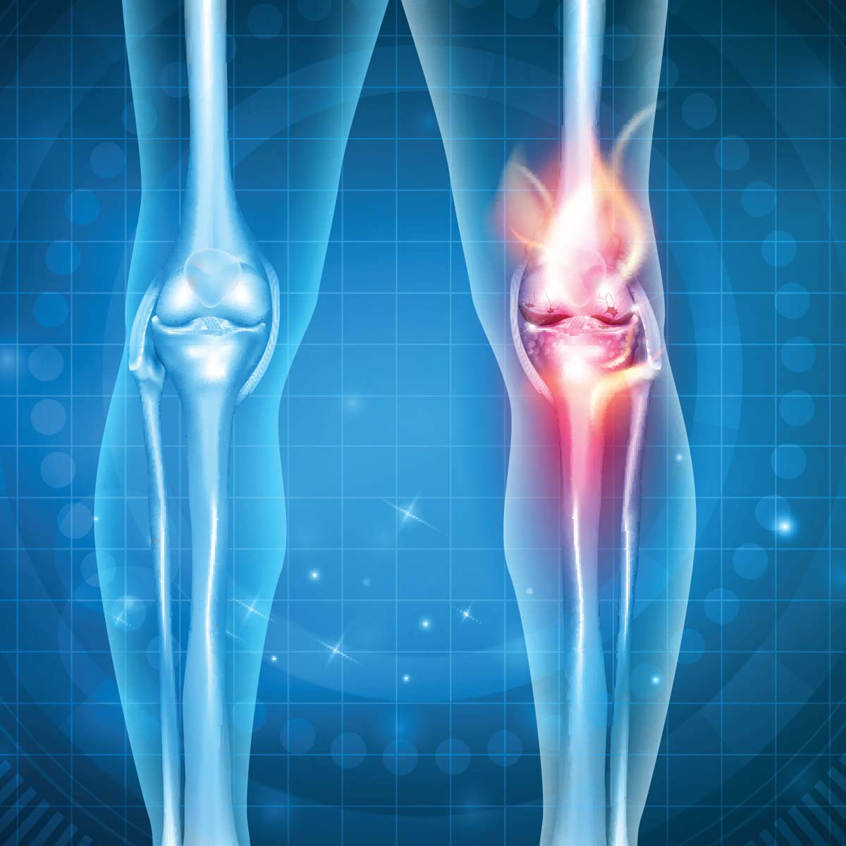 X-ray illustration of a knee joint